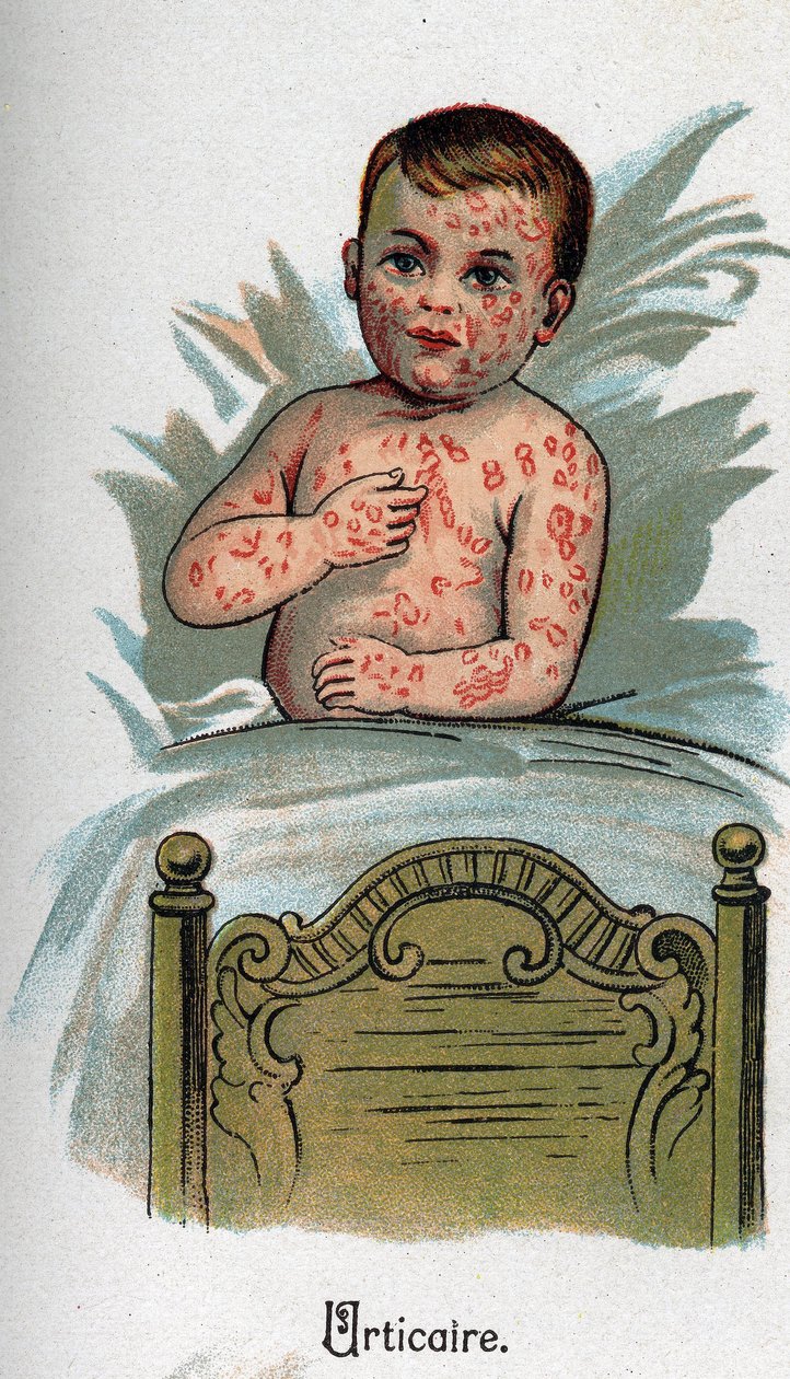 Lasten sairaudet: Nokkosihottuma. F.E. Bilzin teoksessa ”Uusi luonnonlääketiede”. tekijältä Unknown artist