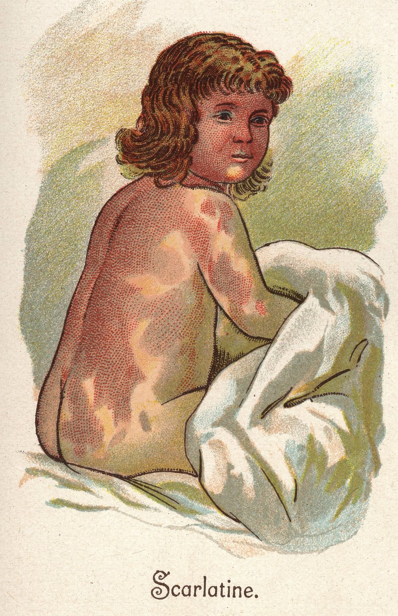 Lasten sairaudet: tulirokko. F.E. Bilzin teoksessa ”Uusi luonnollinen lääke”. tekijältä Unknown artist