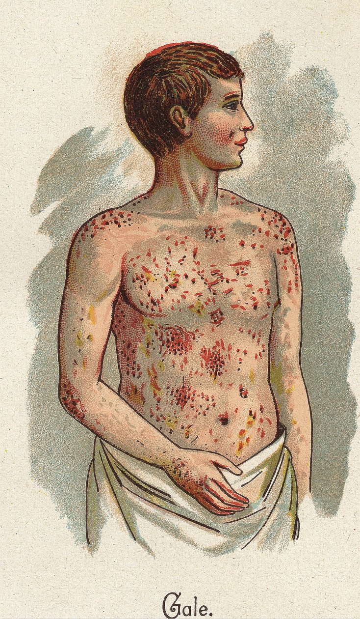 Lasten sairaudet: syyhy. F.E. Bilzin teoksessa ”Uusi luonnollinen lääke”. tekijältä Unknown artist
