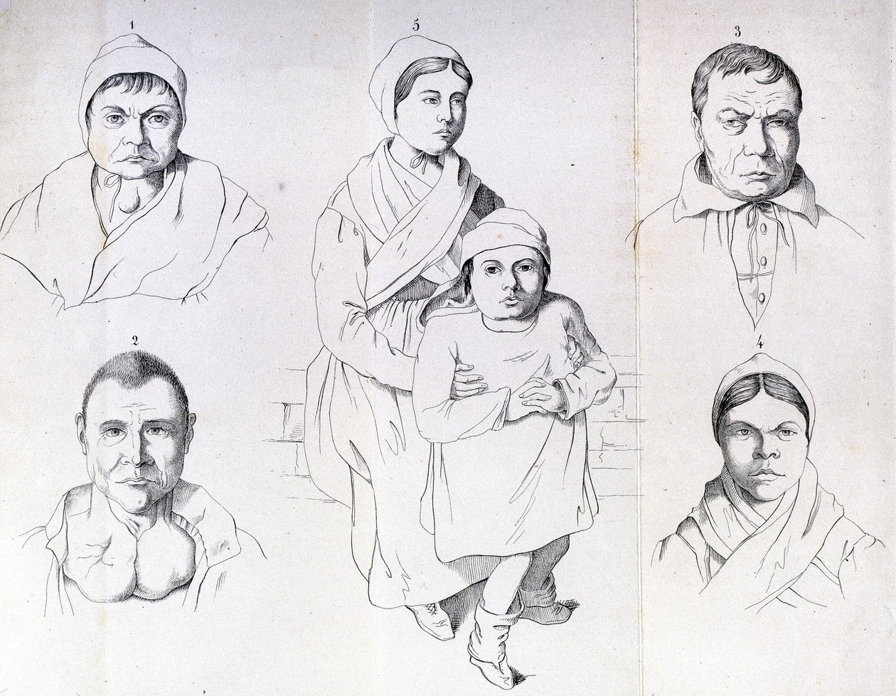 Morelin pohdintoja endeemisen kretinismin syistä. tekijältä Unknown artist
