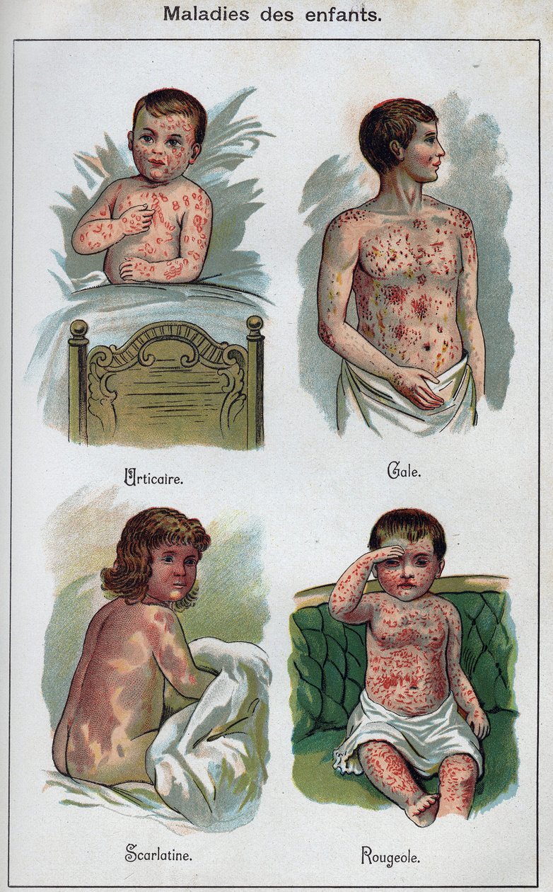 Lasten sairaudet: nokkosihottuma, tuhkarokko, syyhy, tulirokko. F.E. Bilzin teoksessa ”Uusi luonnollinen lääke”. tekijältä Unknown artist