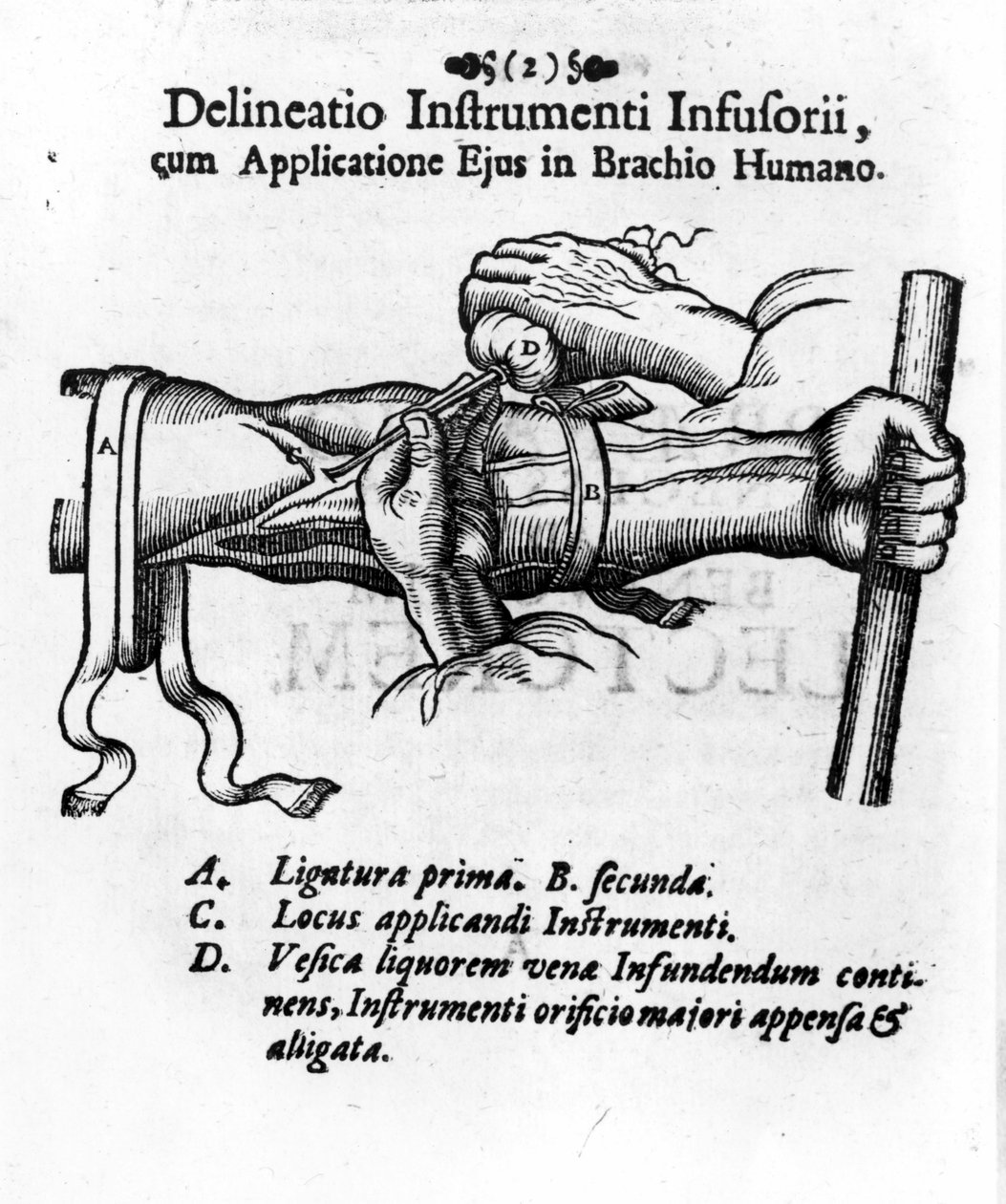 Laskimonsisäinen injektio kuplirakon avulla. kirjoittanut J. D. Mayor, "" Surgery Infusoria", Kilonii 1667 tekijältä Unknown artist