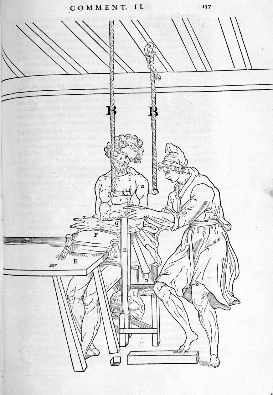 Murtumien vähentäminen. Kilpi, jossa on "" De dissectione partium corporis humani libri kolme... ", kirjoittanut Carlo Stefano Riverio, Pariisi 1545. tekijältä Unknown artist