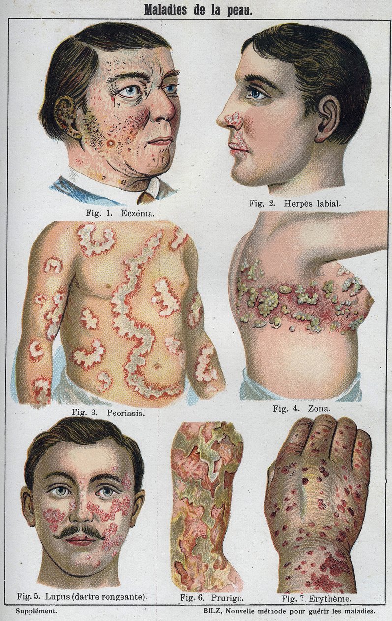 Ihosairaudet: Ekseema, huuliherpes, psoriaasi, vyöruusu, lapus (mädäntyvä tikka), kutina, punoitus. Uusi luonnollinen lääke”, F.E. Bilz. tekijältä Unknown artist