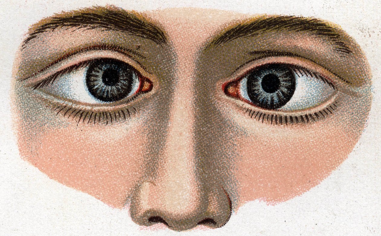 Strabismus lähentyy. "Uusi luonnollinen lääke", kirjoittanut F.E. Bilz. tekijältä Unknown artist