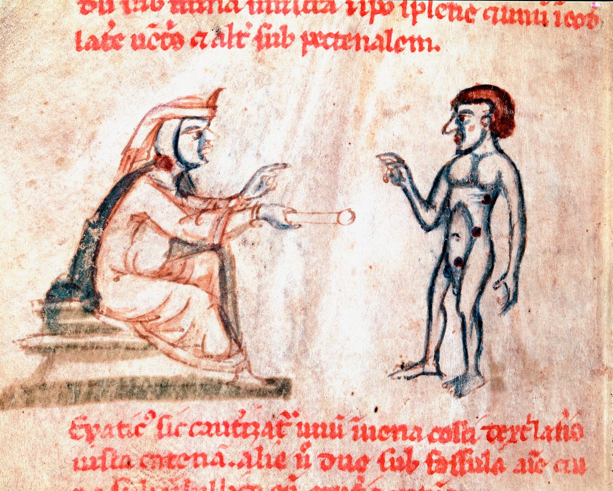 Lääkäri polttaa potilaan kipeille alueille kuumilla raudoilla Miniatyyri käsikirjoituksesta "De Medicina cauteriorum secundum Bruno, Rugerium et Rolthe" 1200-luvulta Paris, B.N. tekijältä Unknown artist