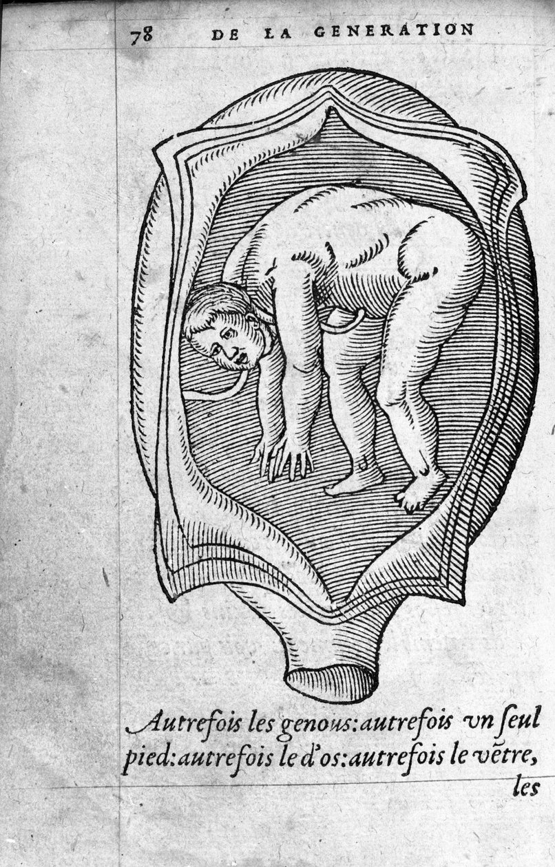 Sikiön sijainti kohdussa raskauden aikana. Kaiverrus ranskalaisen lääkärin ja kirurgin Ambroise Paren (1509-1590) teoksesta "De la Generation des enfants" 1500-luku tekijältä Unknown artist