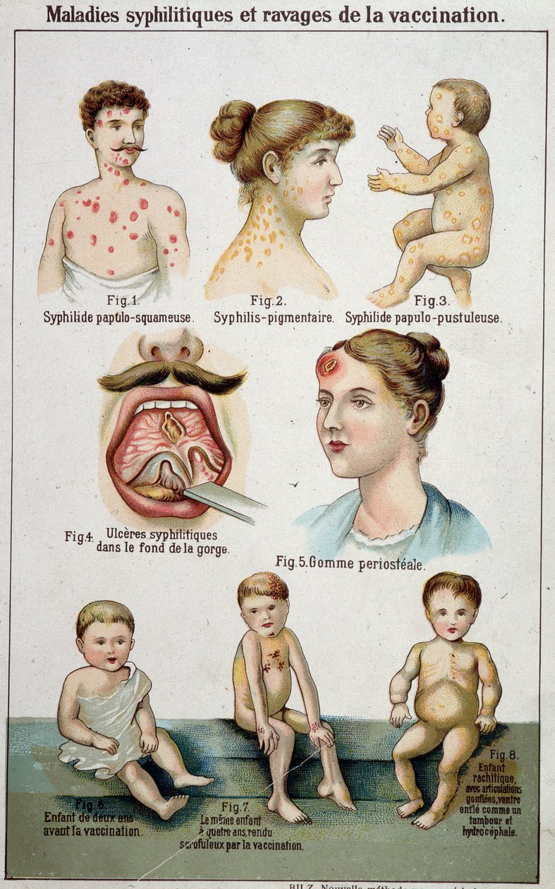 Kilpi havainnollistaa syfiliittisten sairauksien eri asuntoloita ja rokotusten vaaroja - Bilzin luonnonlääketieteessä, 1800-luvun lopulla. tekijältä Unknown artist