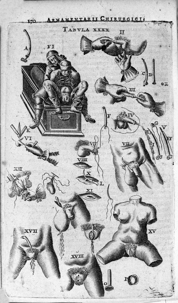 Kirurgiset toimenpiteet nais- ja miessukupuolille. Kaiverrus teokseen "Armamentarium Surgical", kirjoittanut J. Scultetus, Venetsia tekijältä Unknown artist