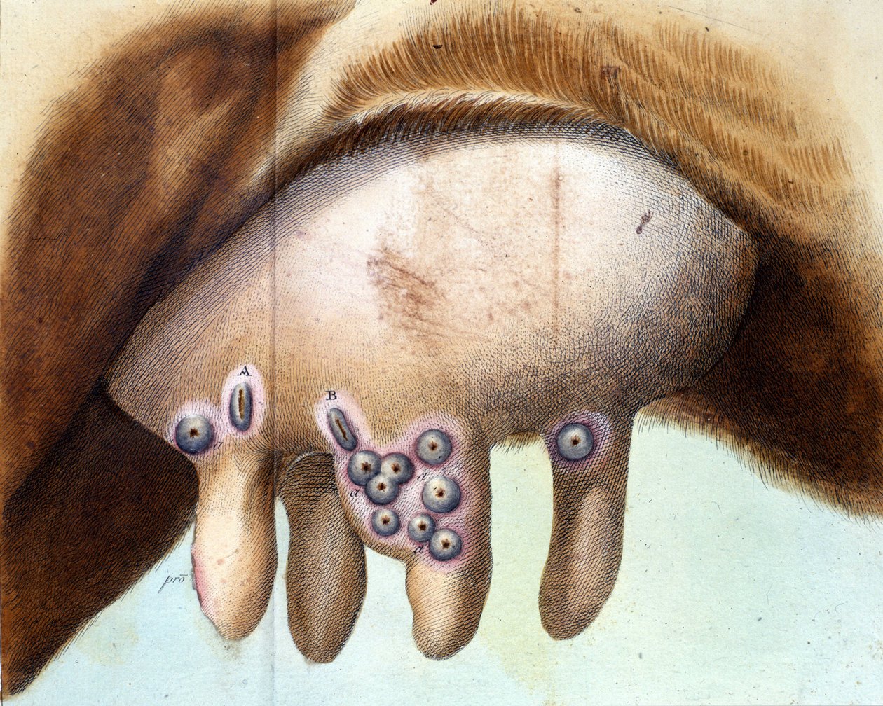 Luigi Saccon (1769-1836) isorokkorokote rokotettiin lehmän rintaa tammikuussa 1801. Lääketieteellinen levy "" Vaccination Treat -tuotteesta, Luigi Sacco, Milano tekijältä Unknown artist