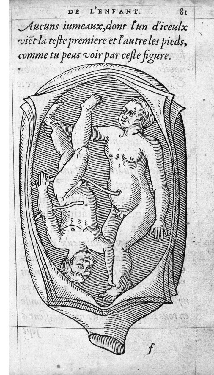 Sikiön asema kohdussa raskauden aikana. Kaiverrus ranskalaisen lääkärin ja kirurgin Ambroise Paren (1509-1590) teoksesta "De la Generation des enfants" 1500-luku tekijältä Unknown artist