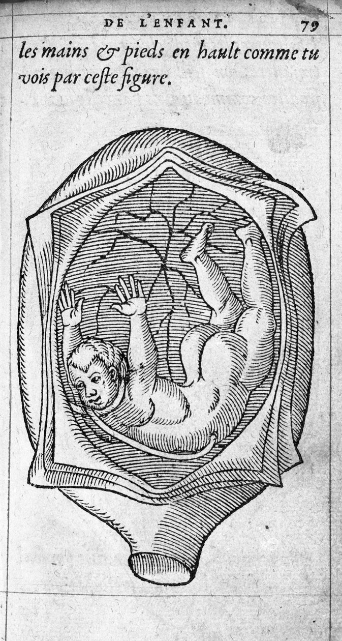 Sikiön asema kohdussa raskauden aikana. Kaiverrus ranskalaisen lääkärin ja kirurgin Ambroise Paren (1509-1590) teoksesta "De la Generation des enfants" 1500-luku tekijältä Unknown artist