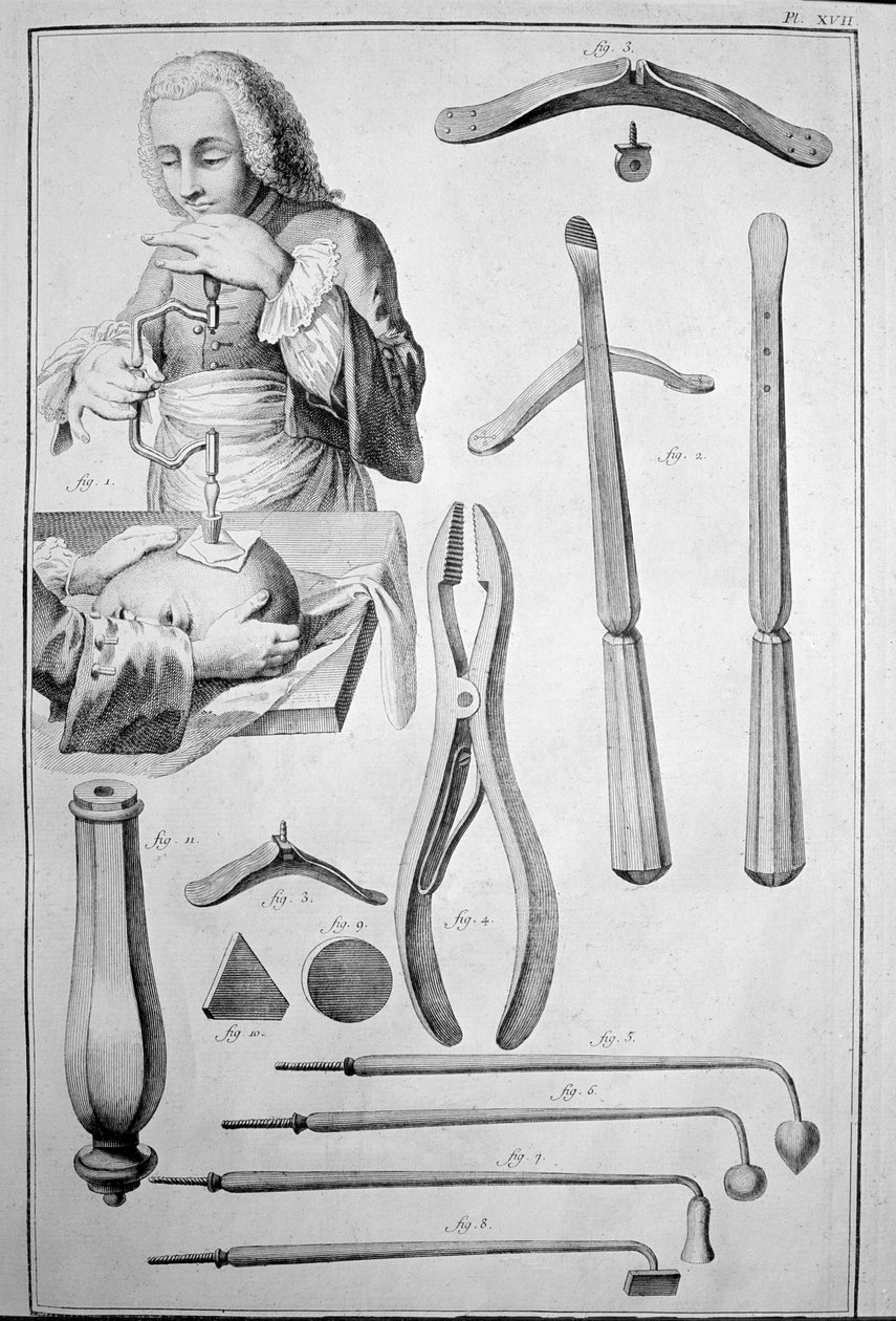 Kallon trepanaatio, erilaiset instrumentit (kaiverrus tekijältä Unknown artist