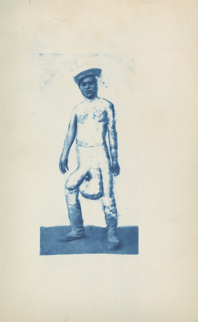 Elefantiasis,c. 1870-luku (kuva) tekijältä Unknown photographer