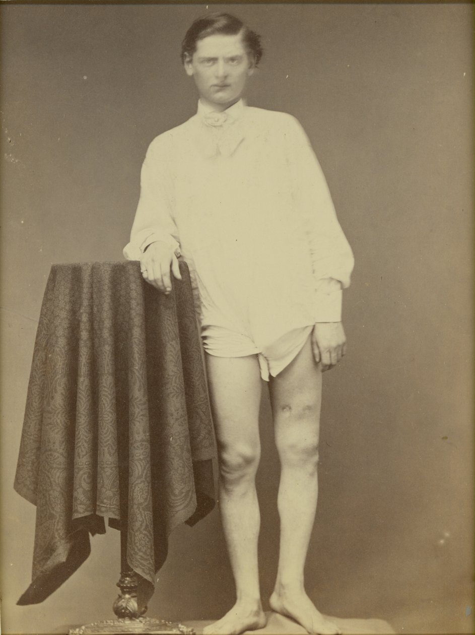 Loukkaantunut sisällissodan sotilas (yksityinen Charles Westerfield, armeijan lääketieteellisen museon näyte nro 4278), huhtikuu 1865, 1865 (albumiprintti) tekijältä William Abraham Bell