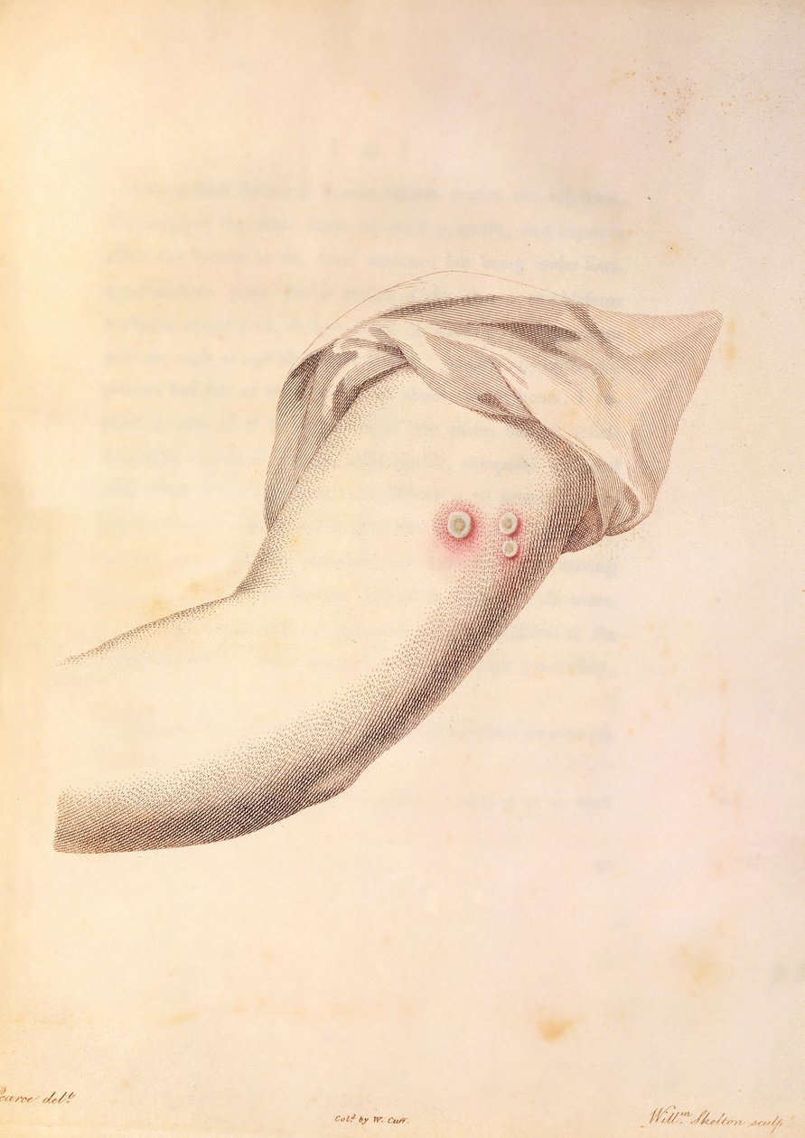 William Peadin käsivarsi, jota käytetään isorokkorokotteeseen, Edward Jennerin (1748-1823) teoksesta Variolae Vaccinaen syitä ja vaikutuksia koskeva tutkimus, Pearcen kaiverrus, n. 1800 tekijältä William Skelton