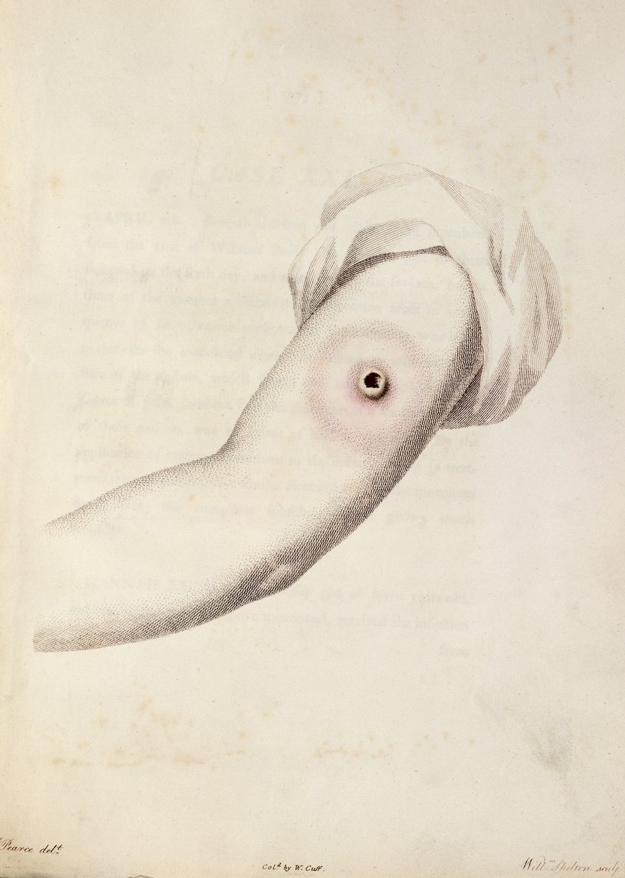 Lehmärokko märkärakkula käsivarressa, Edward Jennerin (1749-1823) teoksesta Variolae Vaccinaen syitä ja vaikutuksia koskeva tutkimus, Pearcen kaiverrus, n. 1800 tekijältä William Skelton