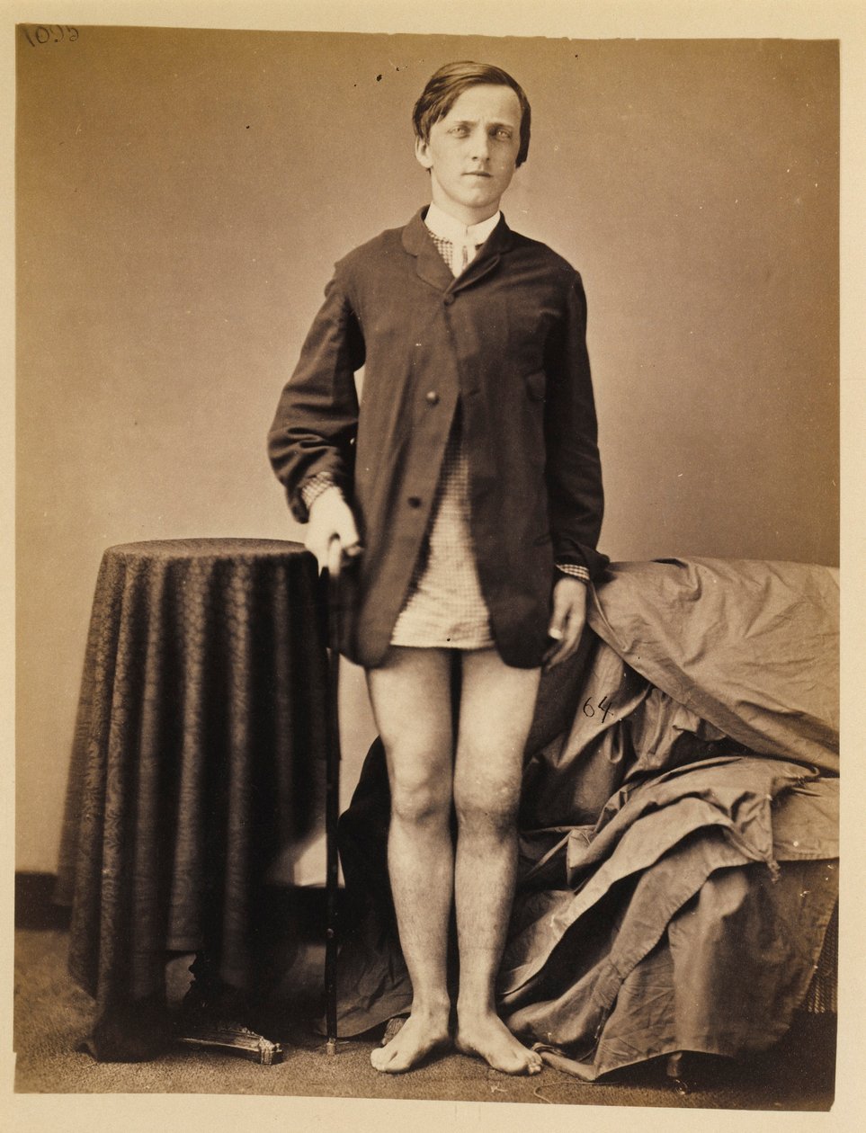 Sotamies G. W. Warrington, toipuminen ilman amputaatiota oikean polvilumpion ampumamurtuman jälkeen, kirurgisen osaston valokuvaluettelosta. tekijältä William Bell