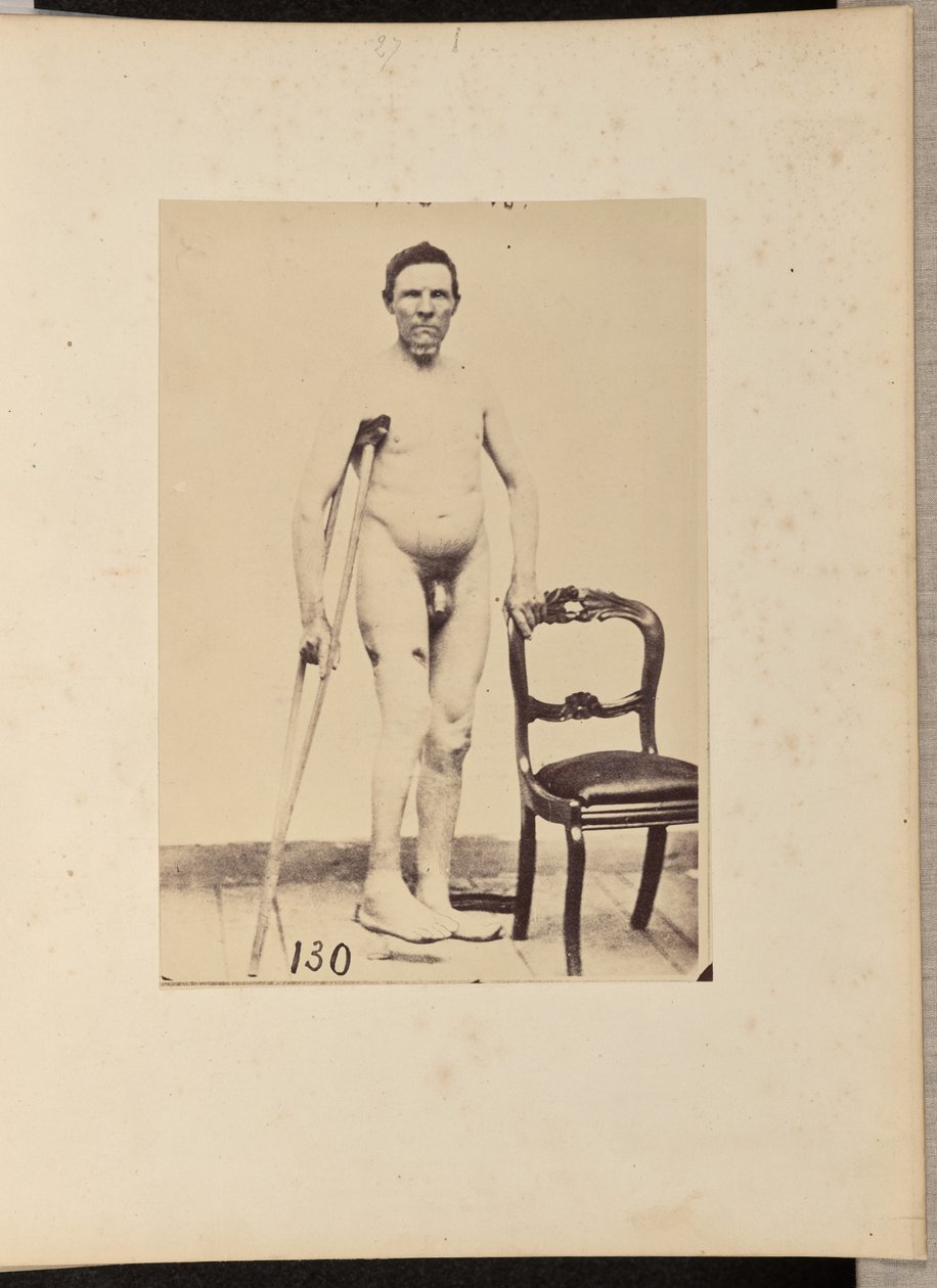 Oikean reisiluun keskimmäisen kolmanneksen yhdistetty ampumamurtuma. tekijältä William H. Bell