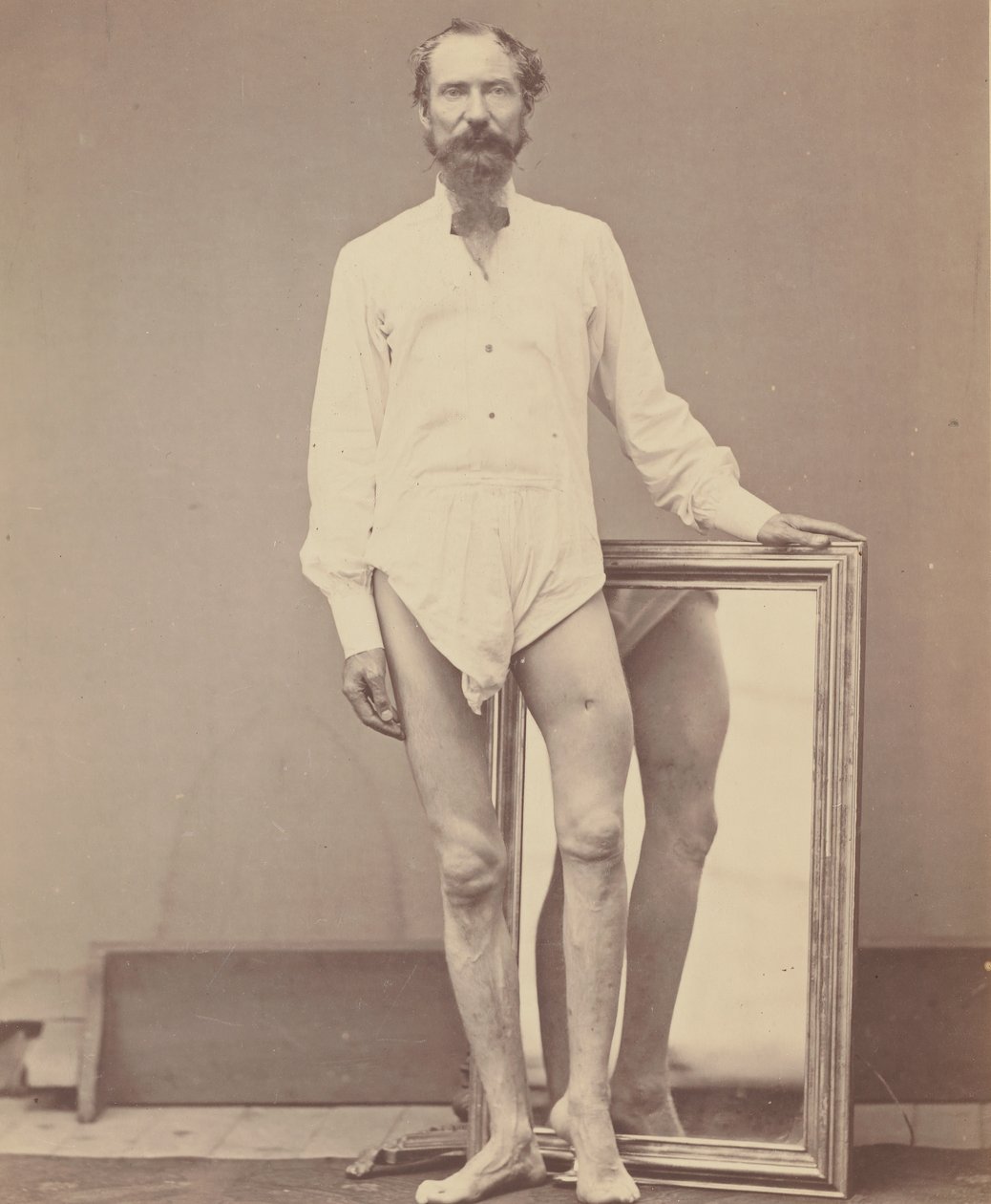 Vasemman reisiluun keskimmäisen kolmanneksen ampumahaava, 1865-67. tekijältä William H. Bell
