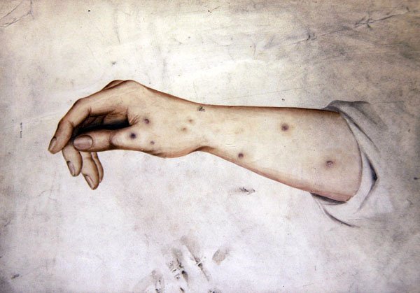 Tutkimus kyynärvarresta, jossa on ihon kunto, n. 1850 (akvarelli paperille) tekijältä William Lover