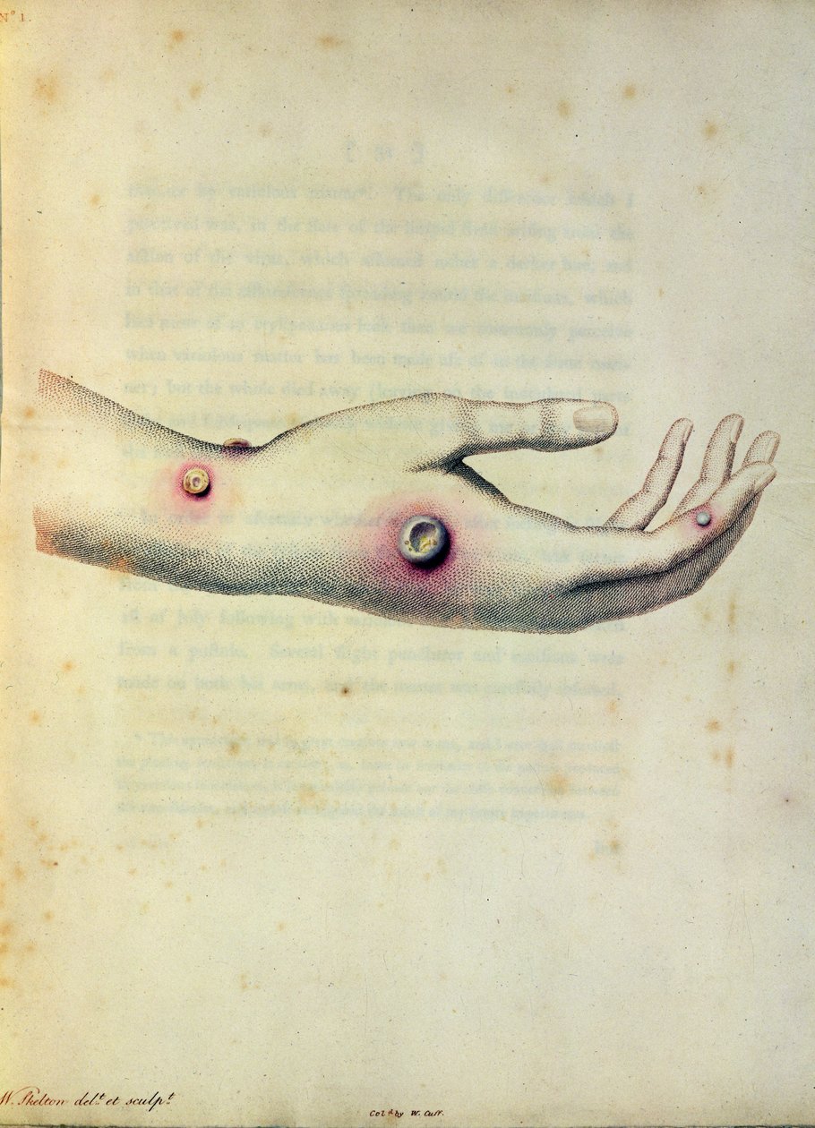 Lehmänrokko märkärakkula Sarah Nelmesin käsivarressa, Pearcen kaivertamasta Edward Jennerin (1749-1823) teoksesta An Inquiry to the Causes and Effects of the Variolae Vaccinae, n. 1800 tekijältä William Skelton