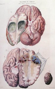 Aivojen syöpäkasvaimet, Jean Cruveilhierin (1791-1874) 1828-42 teoksesta Anatomie Pathologique du Corps Humain (värillinen kaiverrus)