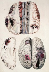 Kapillaarinen apopleksia, Jean Cruveilhierin (1791-1874) teoksesta "Anatomie Pathologique du Corps Humain" 1828-42 (värinen kaiverrus)