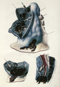Keuhkosairaudet, Jean Cruveilhierin (1791-1874) 1828-42 julkaisusta Anatomie Pathologique du Corps Humain (värillinen kaiverrus) tekijältä Antoine Chazal