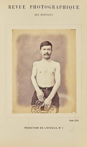 Olkapään resektio, numero 1 tekijältä Arthur de Montmeja