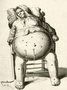 Nesteiden tyhjennys paiseesta, Frederik Dekkers, 1694 tekijältä Dutch School