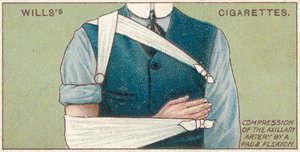 Kainalonvaltimon puristus pehmusteella ja taivutuksella, nro 41 Wills