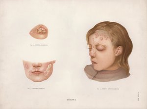 Ihosairaudet: Herpes (väri litho) tekijältä English School