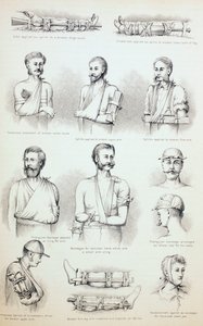 Murtumien väliaikainen hoito, n. 1890 tekijältä English School