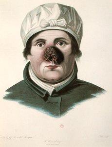 Ennen ihonsiirtoleikkausta, Alexander Auvertin kirjasta 