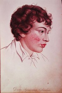 Kuiva laastari, paroni Jean Louis Alibertin (1768-1837) kirjasta Description des Maladies de la Peau. tekijältä French School