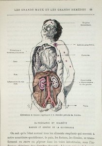Diabeteksen vaikutukset, tohtori J. Rengaden teoksesta "Les Grands Meaux et les Grands Remedes", Pariisi tekijältä French School