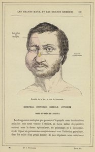 Erisipela de la cara en curs (color lito)finís tekijältä French School