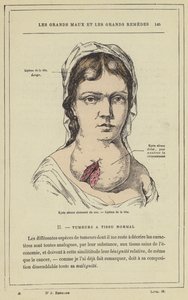 Cloisonnen seroosikysta kaulassa, pään lipoma (väri litho) tekijältä French School