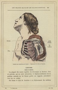 Olkapään subkorakoidinen sijoiltaanmeno, olkaluun pään siirtymä (väri litho) tekijältä French School