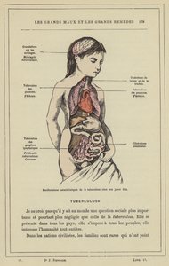 Tuberkuloosin tyypillisiä ilmenemismuotoja nuorella tytöllä (väri litho) tekijältä French School