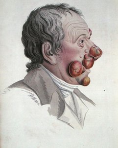 Mycosis Fongoide, Baron Jean Louis Alibertin (1768-1837) kirjasta 1838 (värillinen kaiverrus) tekijältä French School