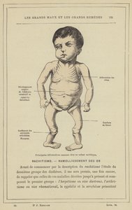 Tärkeimmät luun muodonmuutokset riisitautilapsella (väri litho) tekijältä French School
