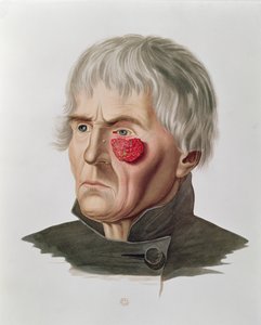 Ihosairaus ennen leikkausta, Alexander Auvertin Selecta Praxis Medico-Chirurgica, Pariisi, 1856 tekijältä French School