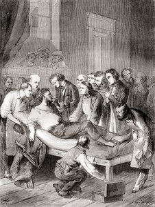 Amerikkalaisen hammaslääkärin William Thomas Green Mortonin ensimmäinen julkinen esitys inhaloitavan eetterin käytöstä kirurgisena anestesiana vuonna 1846 Les Merveilles de la Science -julkaisusta, julkaistu noin 1870 tekijältä French School