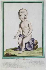 Lapsi, jolla on epämuodostunut pää, "Les Ecarts de la Nature", Pariisi, 1775