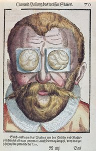 Silmäsairauden hoito, Georg Bartischin (1535-1636) Ophthalmodouleiasta, joka julkaistiin Dresdenissä vuonna 1583 (värillinen puupainatus) tekijältä German School