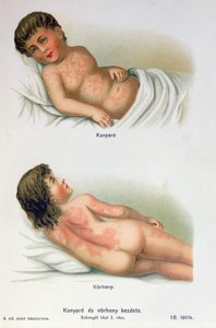 Tuhkarokko ja tulirokko, perhelääkärikirjasta, n. 1900 tekijältä Hungarian School