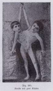 Giacomo ja Giovanni Battista Tocci, italialaiset kaksoset (valkoinen kuva)
