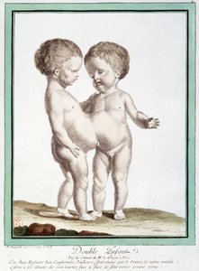Siamilaiset lapset - Régnaultin "" Luonnon poikkeamat" -osassa tekijältä Jean Baptiste Regnault